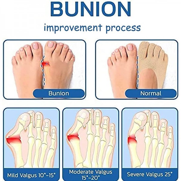 Orthoes Bunion Relief Socks Women - Orthopedic Toe Compression Sock - Projoint Antibunions Health Sock - Sock Align Toe Socks for Bunion - Anti Bunion Socks for Women and Men Orthoes Bunion Relief Socks Women - Orthopedic Toe Compression Sock - Projoint Antibunions Health Sock - Sock Align Toe Socks for Bunion - Anti Bunion Socks for Women and Men